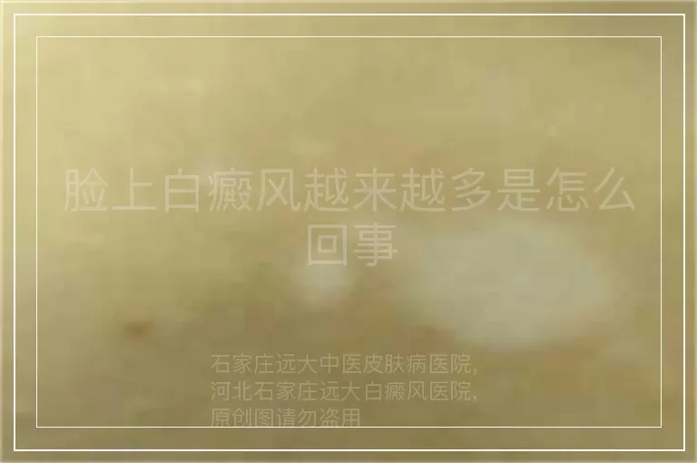 脸上白癜风越来越多是怎么回事