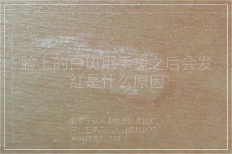 脸上的白斑用手搓之后会发红是什么原因
