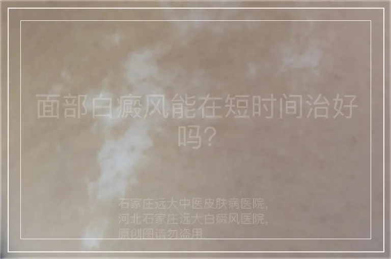 面部白癜风能在短时间治好吗？
