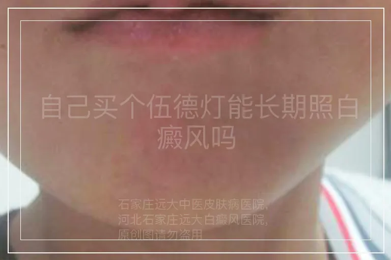 自己买个伍德灯能长期照白癜风吗