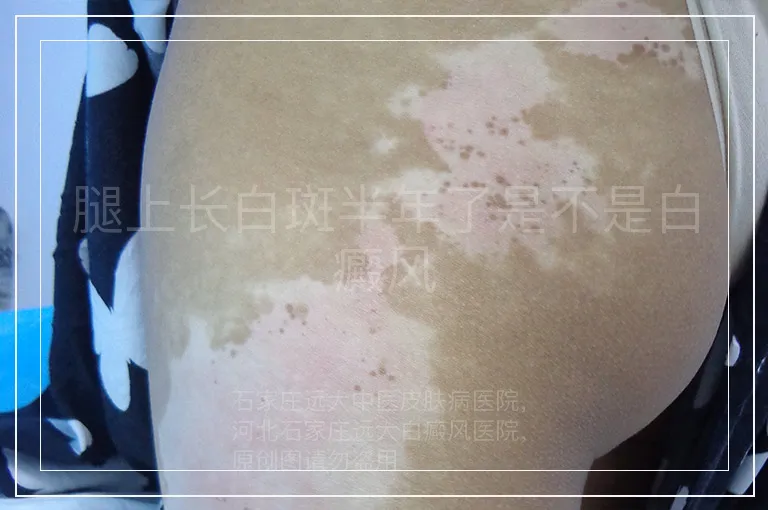 腿上长白斑半年了是不是白癜风