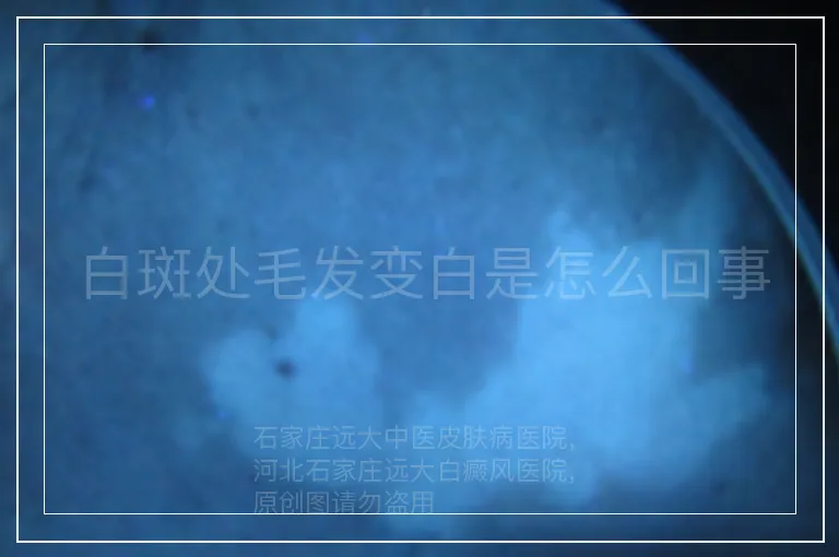 白斑处毛发变白是怎么回事