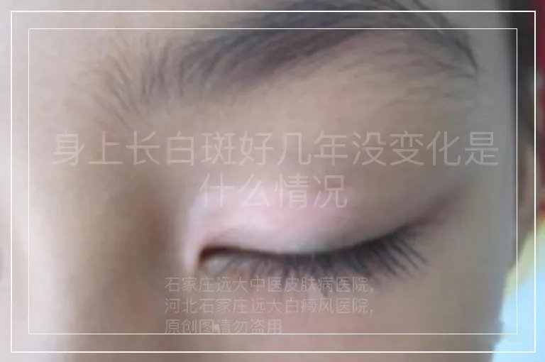 身上长白斑好几年没变化是什么情况