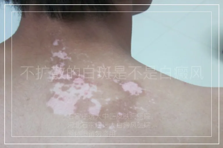 不扩散的白斑是不是白癜风