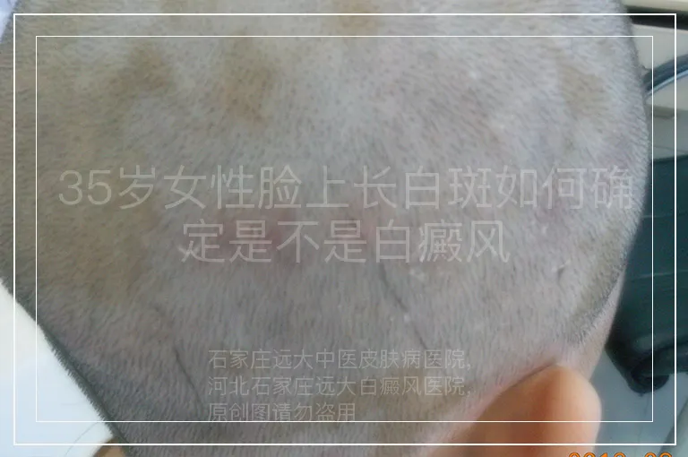 35岁女性脸上长白斑如何确定是不是白癜风