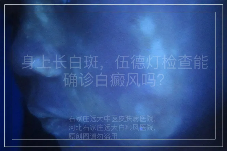 身上长白斑，伍德灯检查能确诊白癜风吗？