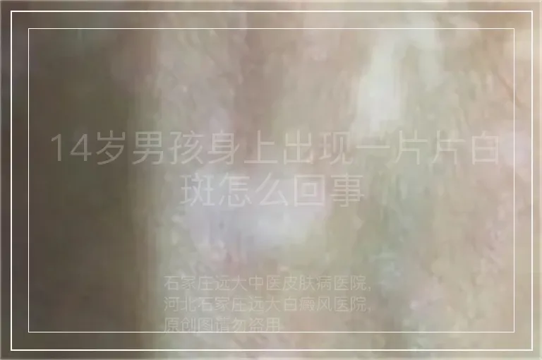 14岁男孩身上出现一片片白斑怎么回事