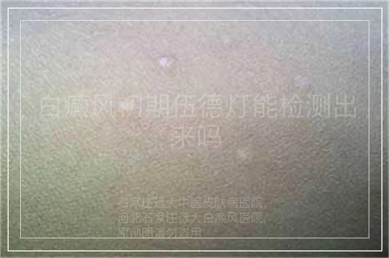 白癜风初期伍德灯能检测出来吗