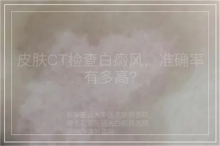 皮肤CT检查白癜风，准确率有多高？