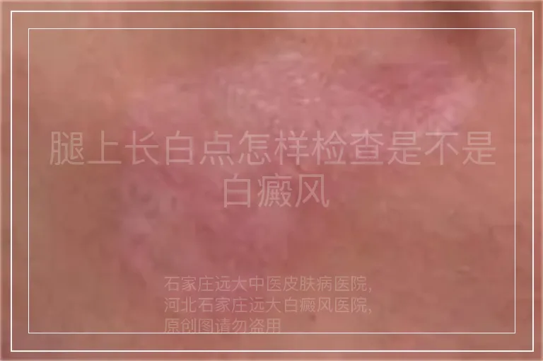 腿上长白点怎样检查是不是白癜风