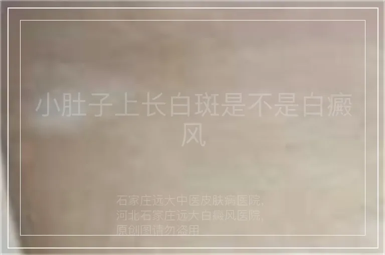小肚子上长白斑是不是白癜风