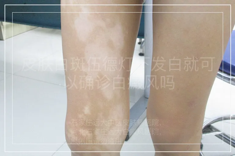 皮肤白斑伍德灯下发白就可以确诊白癜风吗