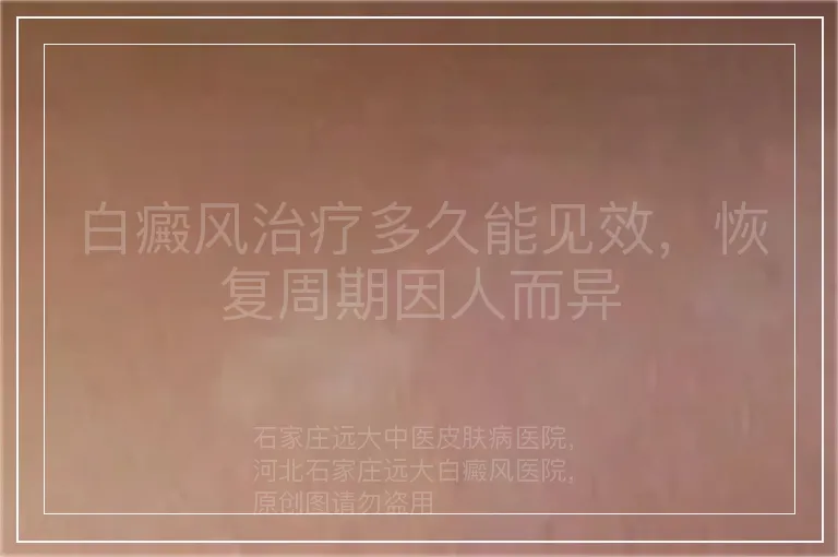 白癜风治疗多久能见效,恢复周期因人而异