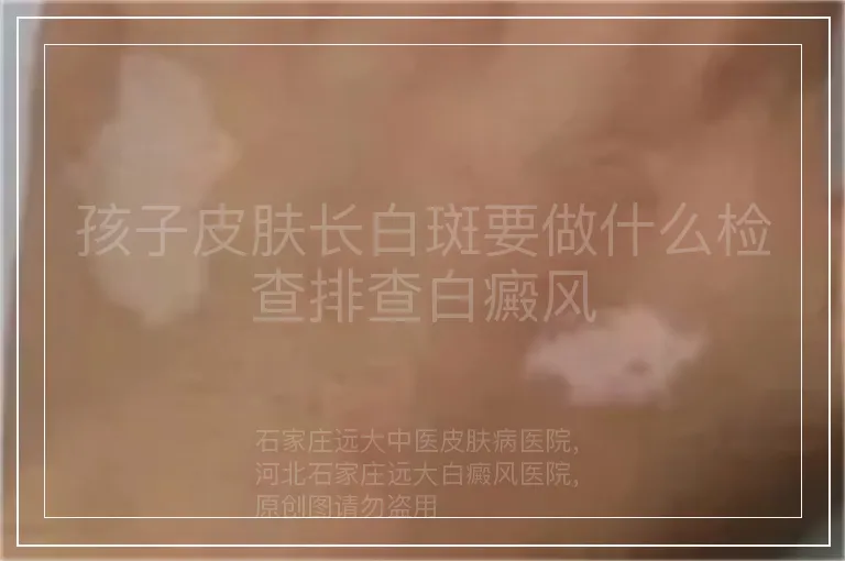 孩子皮肤长白斑要做什么检查排查白癜风