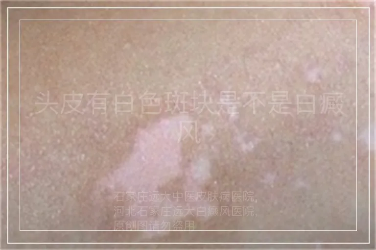 头皮有白色斑块是不是白癜风