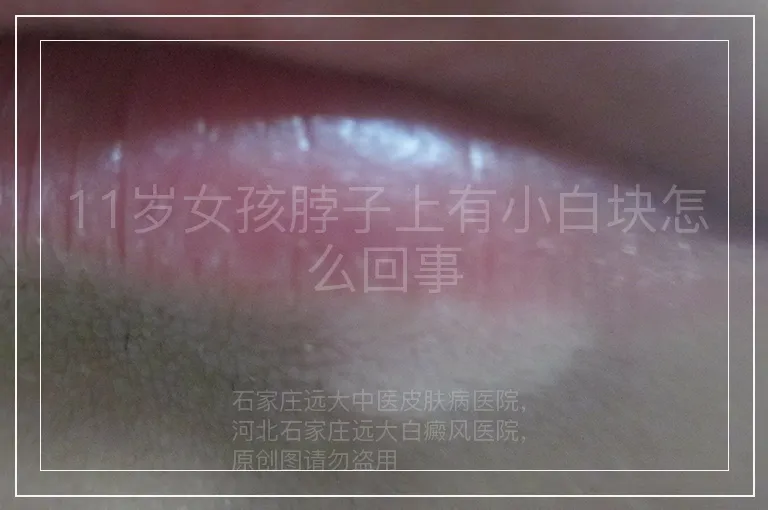 11岁女孩脖子上有小白块怎么回事