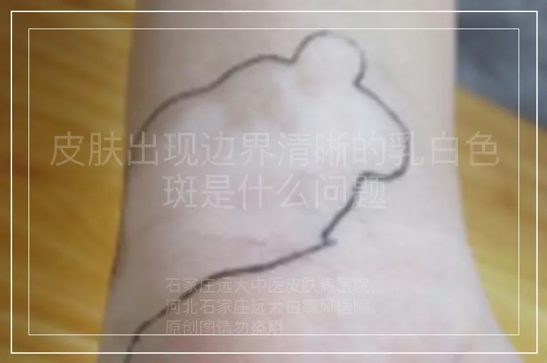 皮肤出现边界清晰的乳白色斑是什么问题