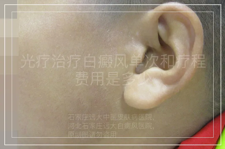 光疗治疗白癜风单次和疗程费用是多少