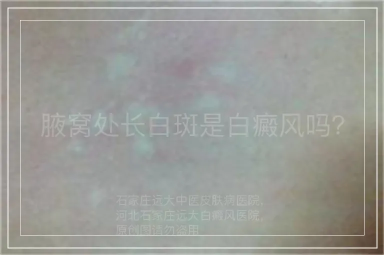 腋窝处长白斑是白癜风吗?