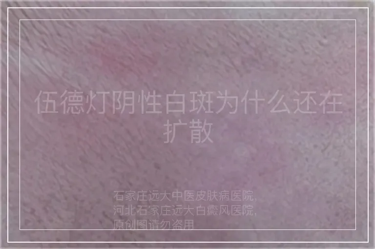 伍德灯阴性白斑为什么还在扩散