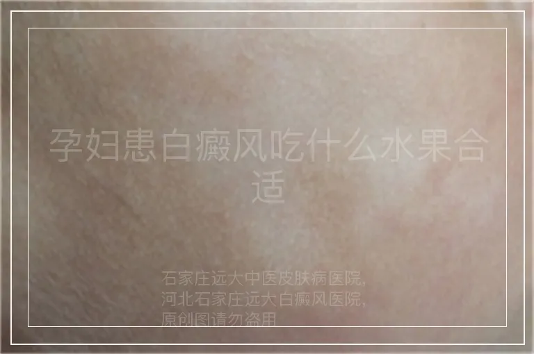孕妇患白癜风吃什么水果合适
