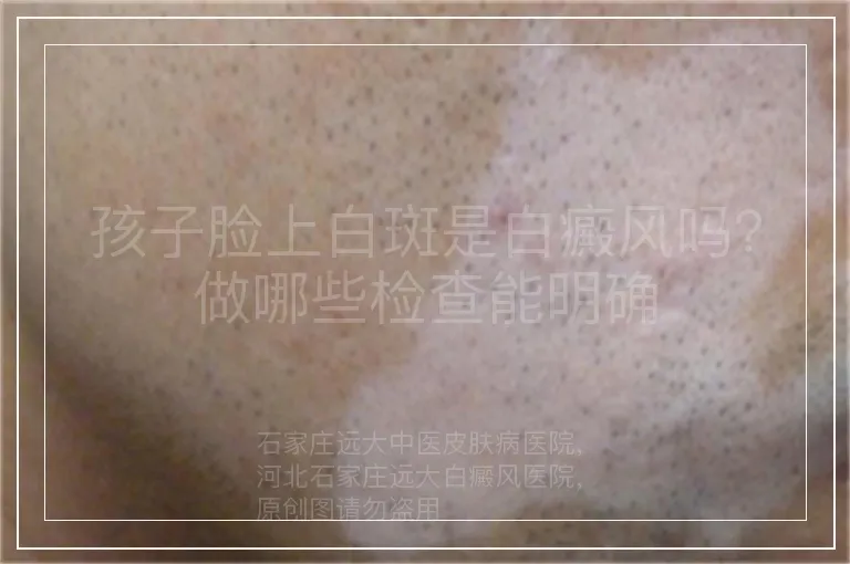 孩子脸上白斑是白癜风吗？做哪些检查能明确