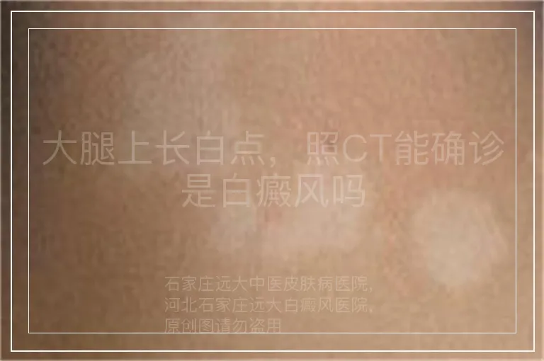 大腿上长白点，照CT能确诊是白癜风吗