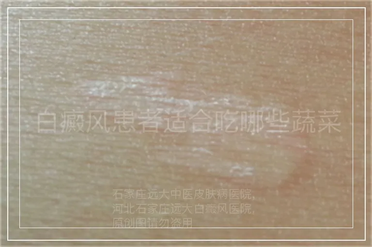 白癜风患者适合吃哪些蔬菜