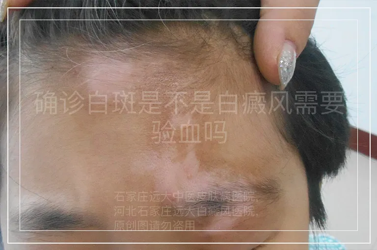 确诊白斑是不是白癜风需要验血吗