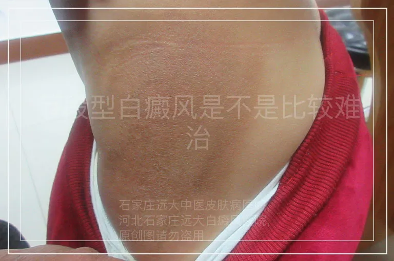 节段型白癜风是不是比较难治