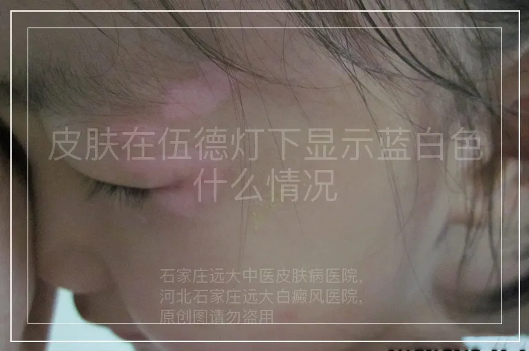 皮肤在伍德灯下显示蓝白色什么情况