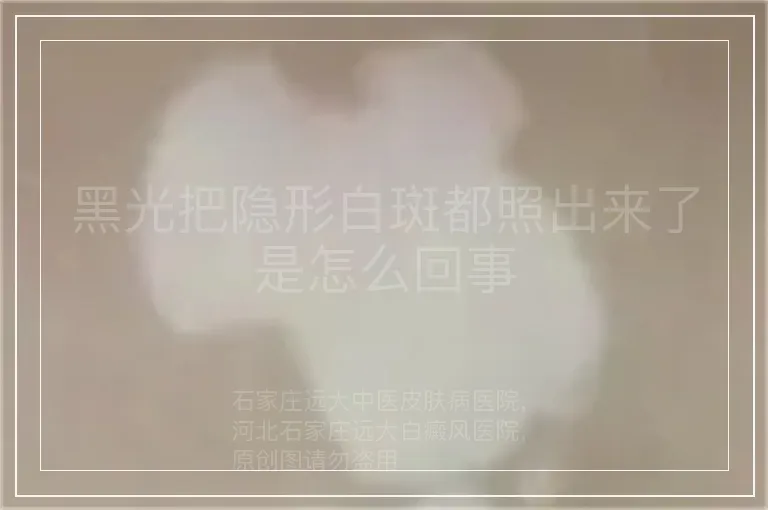 黑光把隐形白斑都照出来了是怎么回事