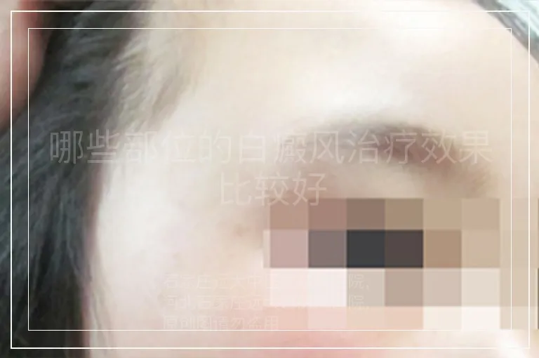 哪些部位的白癜风治疗效果比较好