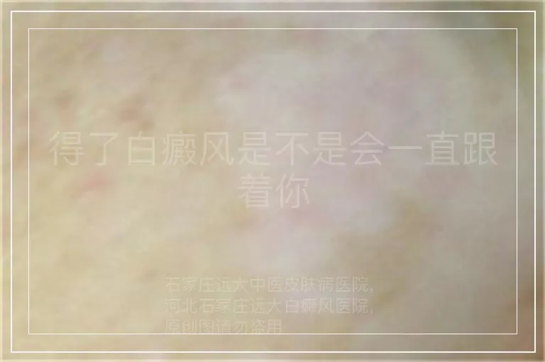 得了白癜风是不是会一直跟着你