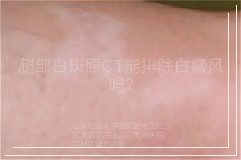 腿部白斑照CT能排除白癜风吗？