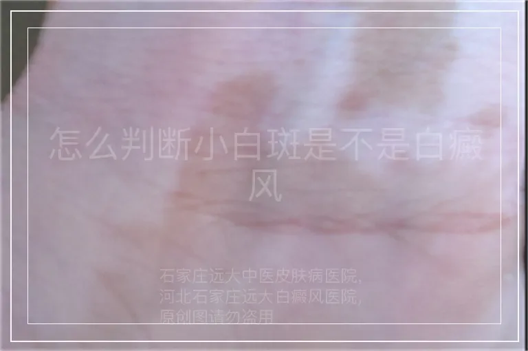 怎么判断小白斑是不是白癜风