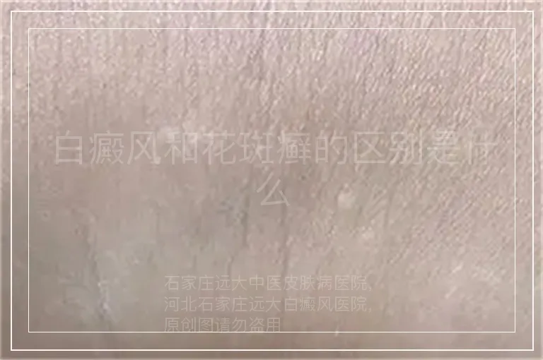 白癜风和花斑癣的区别是什么