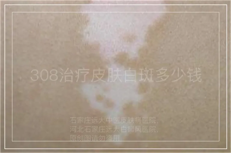 308治疗皮肤白斑多少钱