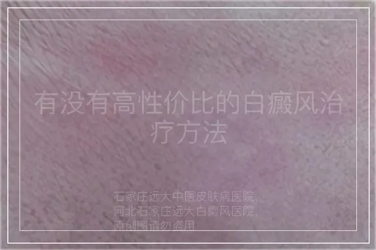 有没有高性价比的白癜风治疗方法