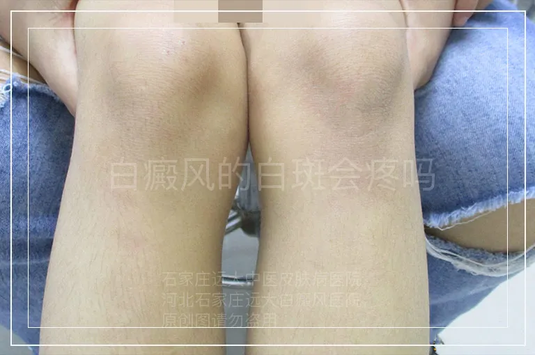 白癜风的白斑会疼吗