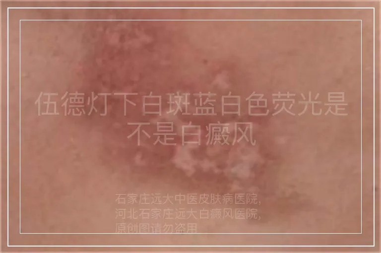 伍德灯下白斑蓝白色荧光是不是白癜风