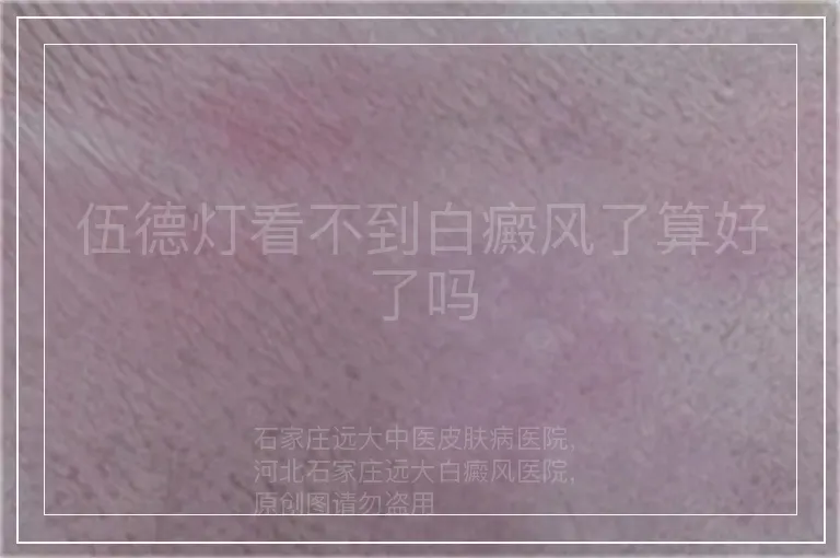 伍德灯看不到白癜风了算好了吗