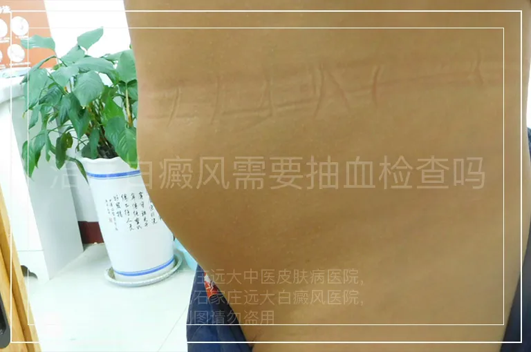 治疗白癜风需要抽血检查吗