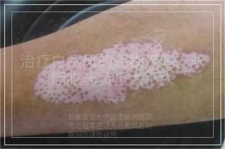 治疗白癜风的药物贵吗,长期吃药负担大不大