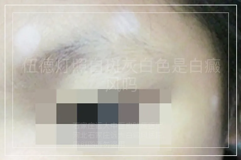 伍德灯照白斑灰白色是白癜风吗