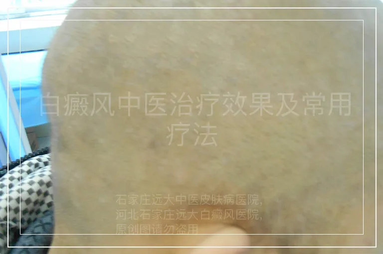 白癜风中医治疗效果及常用疗法