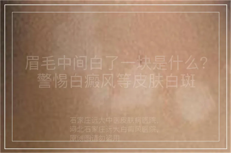 眉毛中间白了一块是什么？警惕白癜风等皮肤白斑