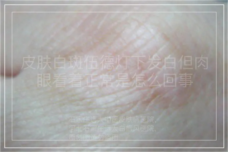 皮肤白斑伍德灯下发白但肉眼看着正常是怎么回事