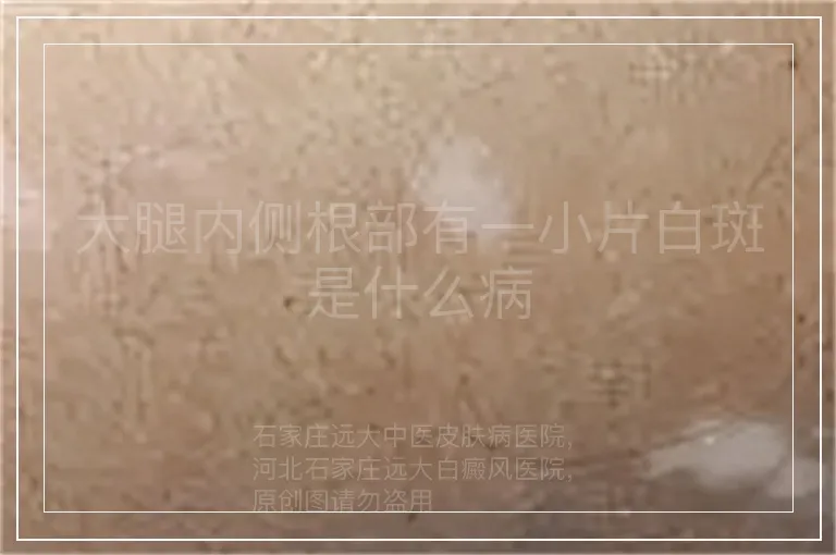 大腿内侧根部有一小片白斑是什么病