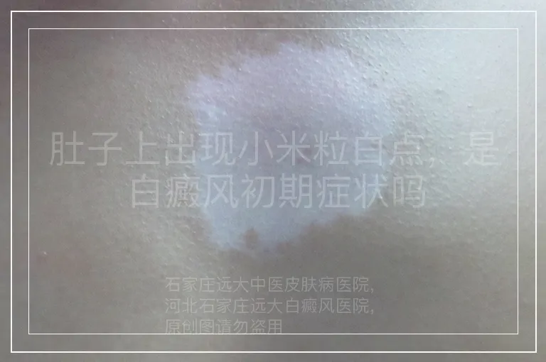 肚子上出现小米粒白点，是白癜风初期症状吗